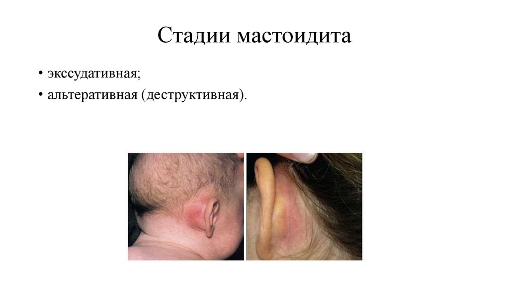 Стадии мастоидита