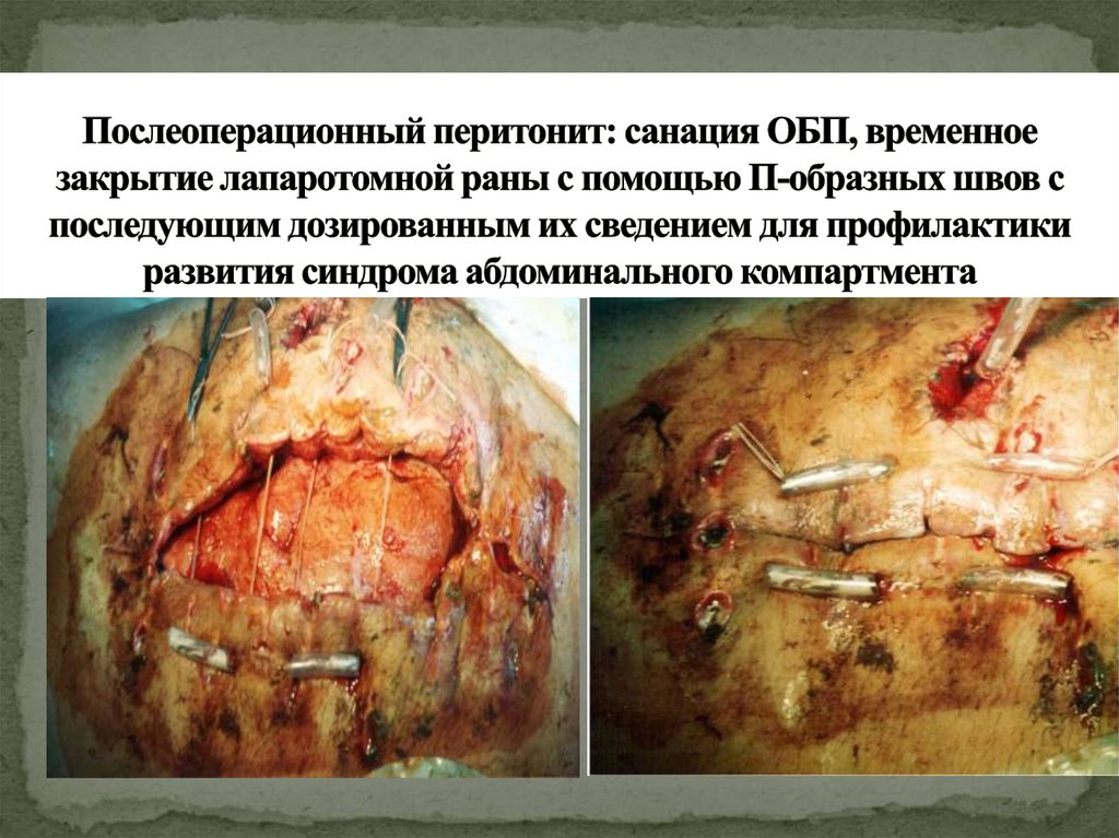 Послеоперационный перитонит: санация ОБП, временное закрытие лапаротомной раны с помощью П-образных швов с последующим