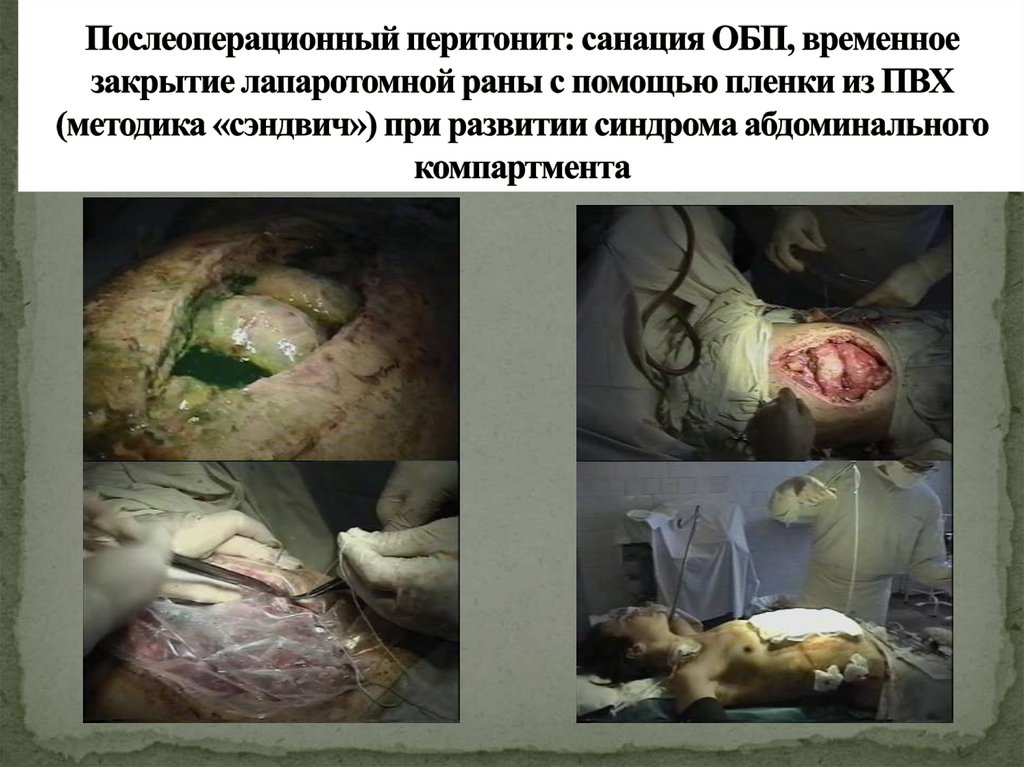 Послеоперационный перитонит: санация ОБП, временное закрытие лапаротомной раны с помощью пленки из ПВХ (методика «сэндвич») при