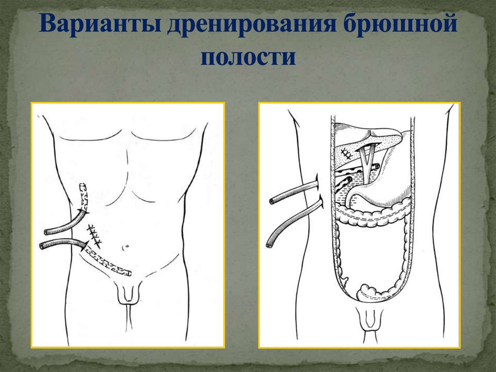 Варианты дренирования брюшной полости