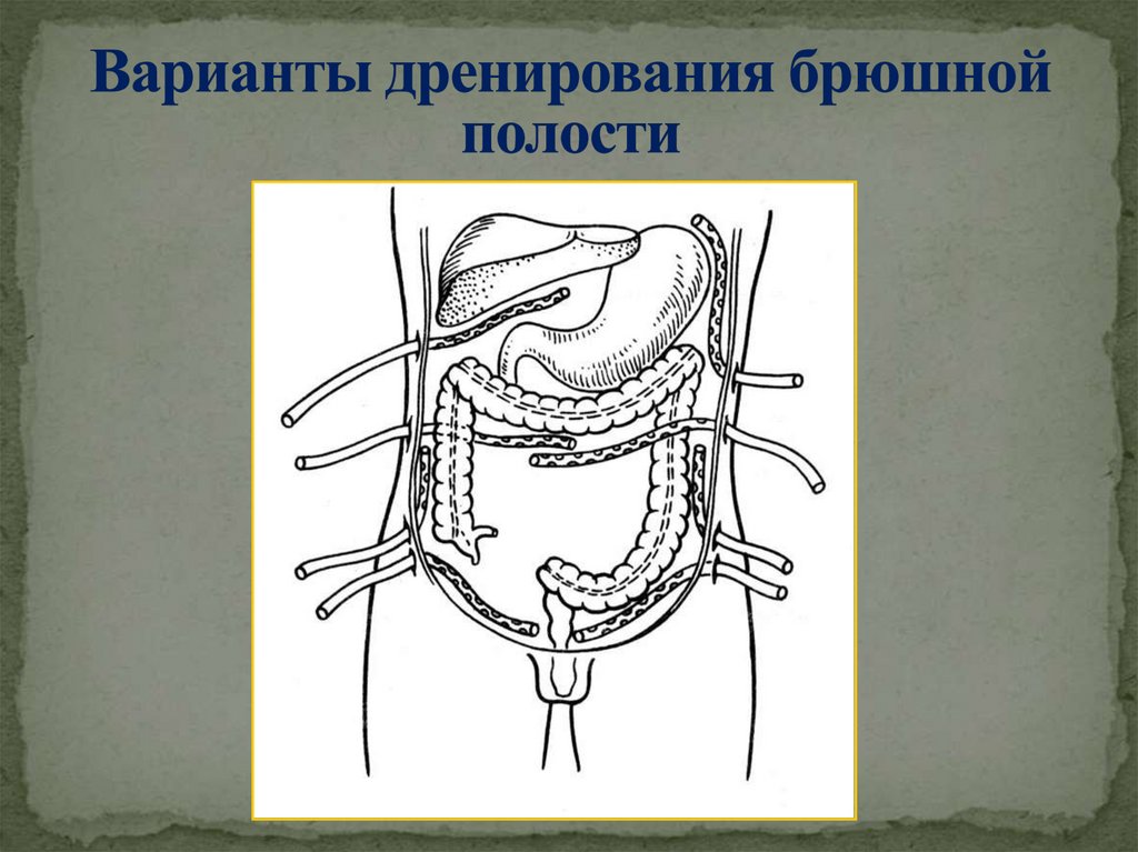 Варианты дренирования брюшной полости