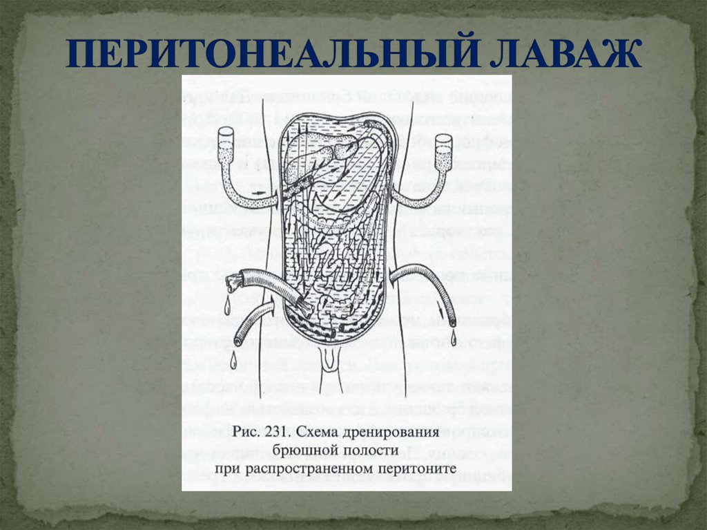 ПЕРИТОНЕАЛЬНЫЙ ЛАВАЖ