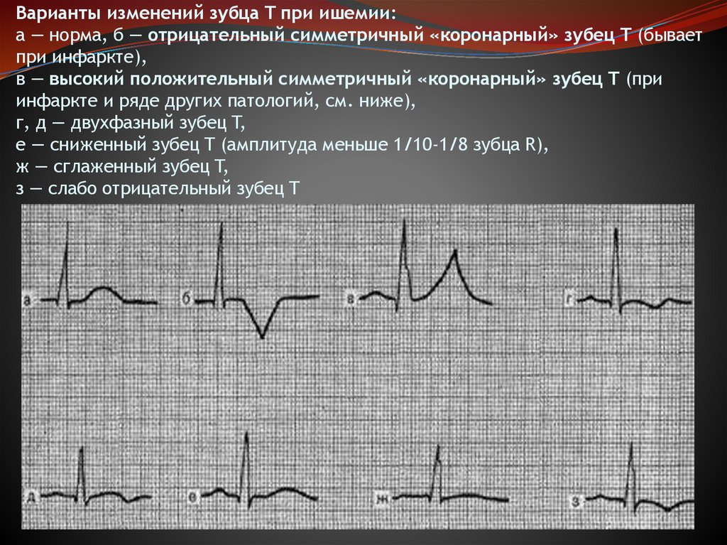 Варианты изменений зубца T при ишемии: а — норма, б — отрицательный симметричный «коронарный» зубец T (бывает при инфаркте), в