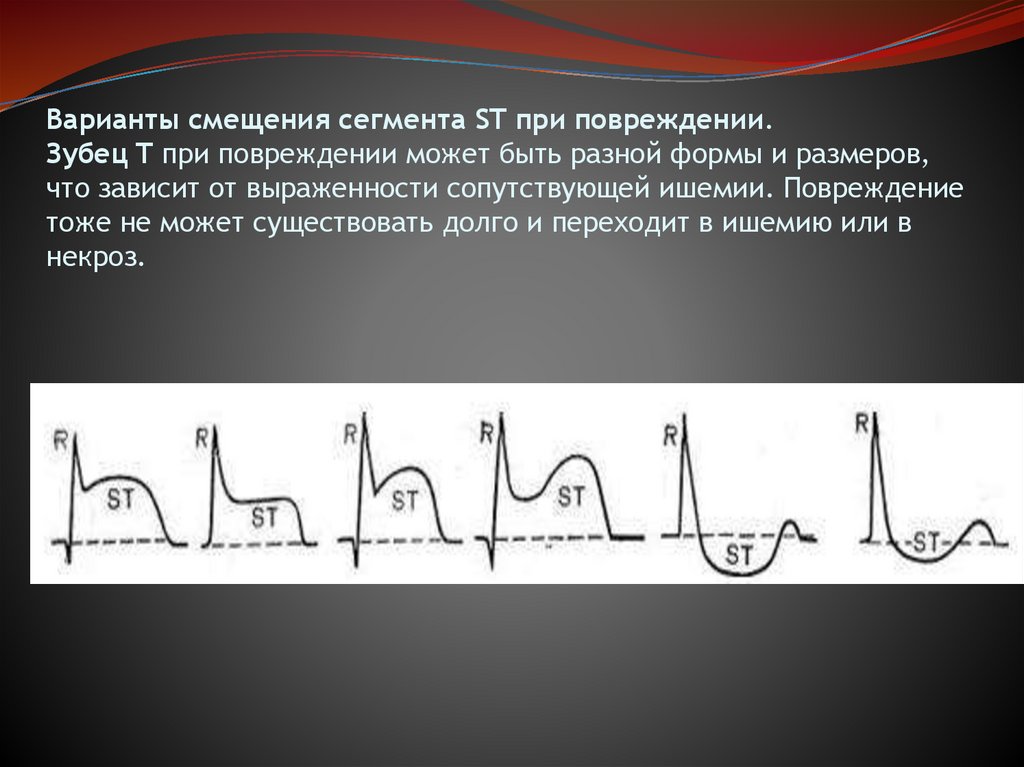 Варианты смещения сегмента ST при повреждении. Зубец T при повреждении может быть разной формы и размеров, что зависит от