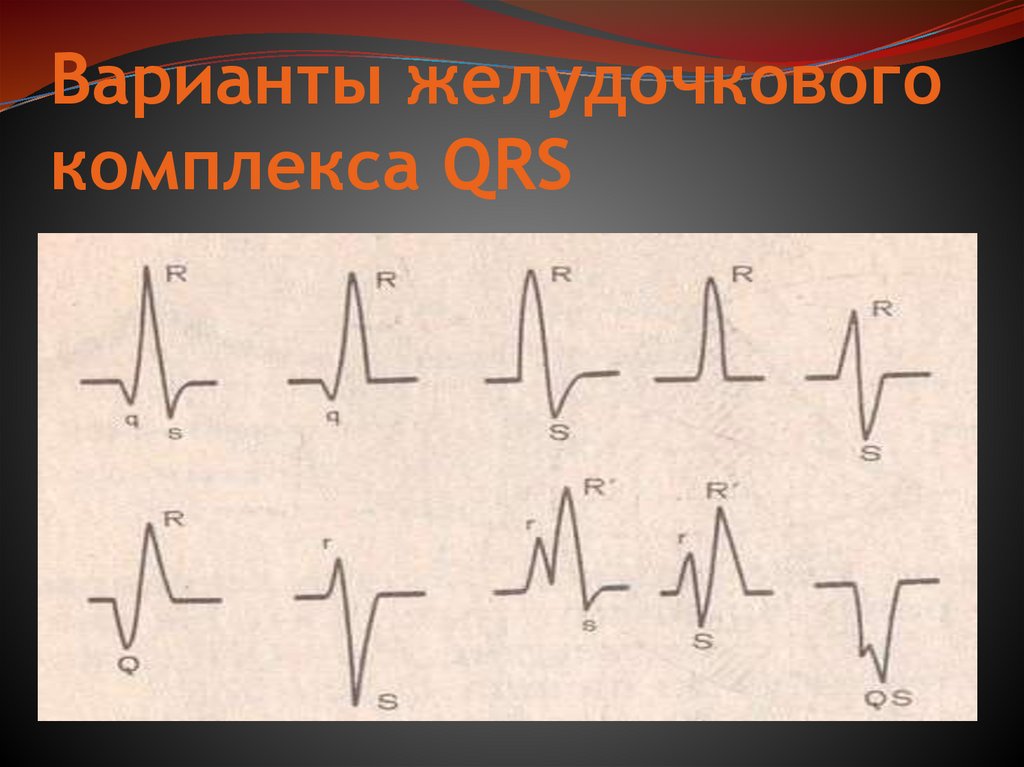 Варианты желудочкового комплекса QRS