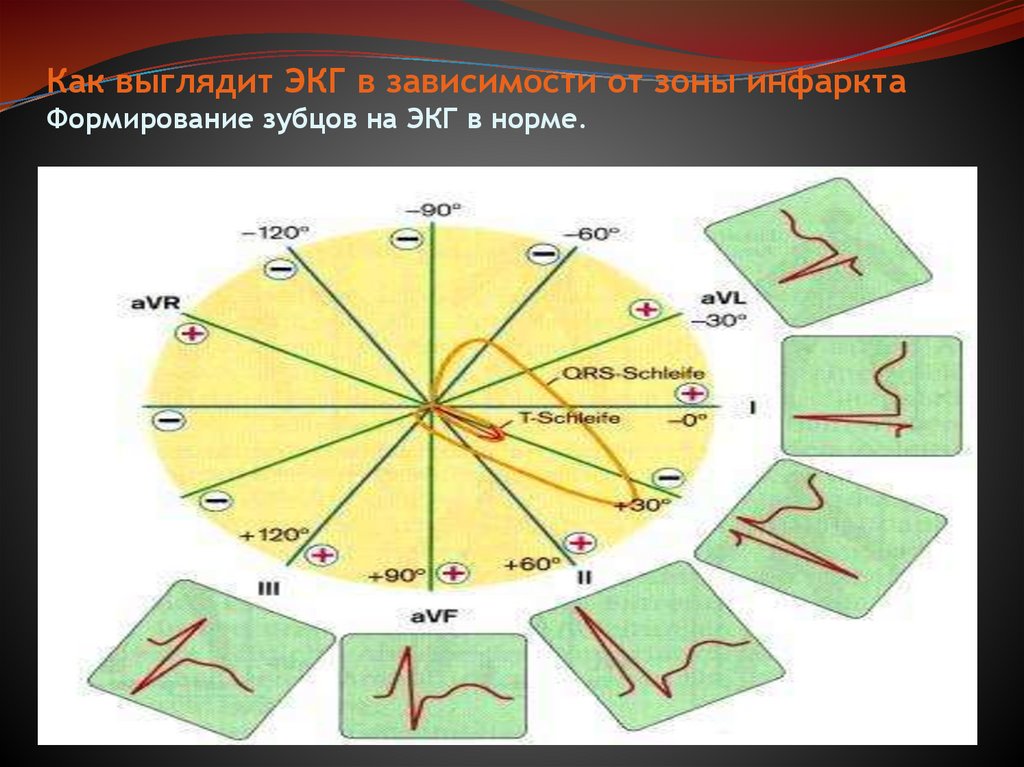 Как выглядит ЭКГ в зависимости от зоны инфаркта Формирование зубцов на ЭКГ в норме.
