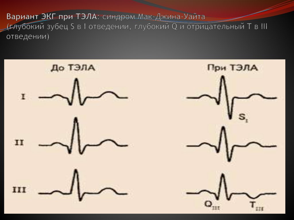 Вариант ЭКГ при ТЭЛА: синдром Мак-Джина-Уайта (глубокий зубец S в I отведении, глубокий Q и отрицательный Т в III отведении)