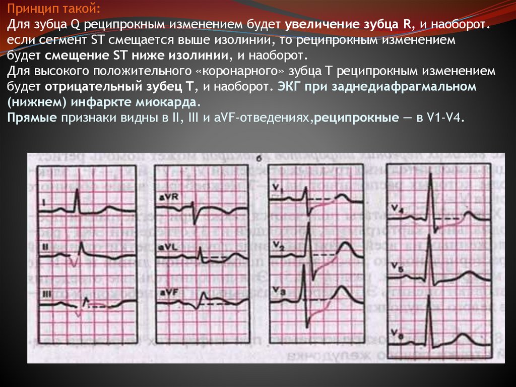 Принцип такой: Для зубца Q реципрокным изменением будет увеличение зубца R, и наоборот. если сегмент ST смещается выше