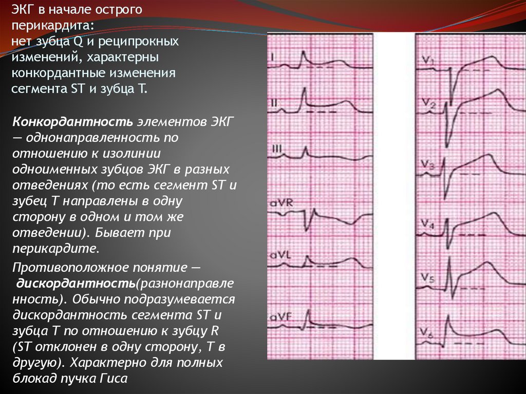 ЭКГ в начале острого перикардита: нет зубца Q и реципрокных изменений, характерны конкордантные изменения сегмента ST и зубца