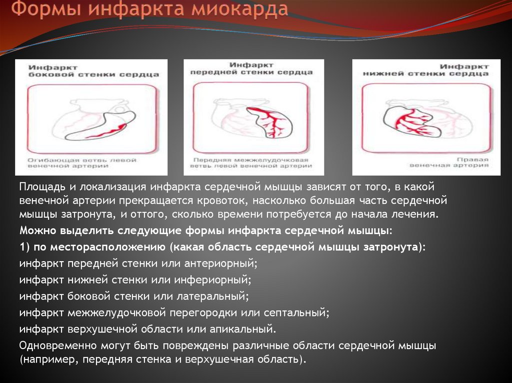 Формы инфаркта миокарда