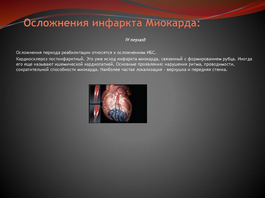 Осложнения инфаркта Миокарда: