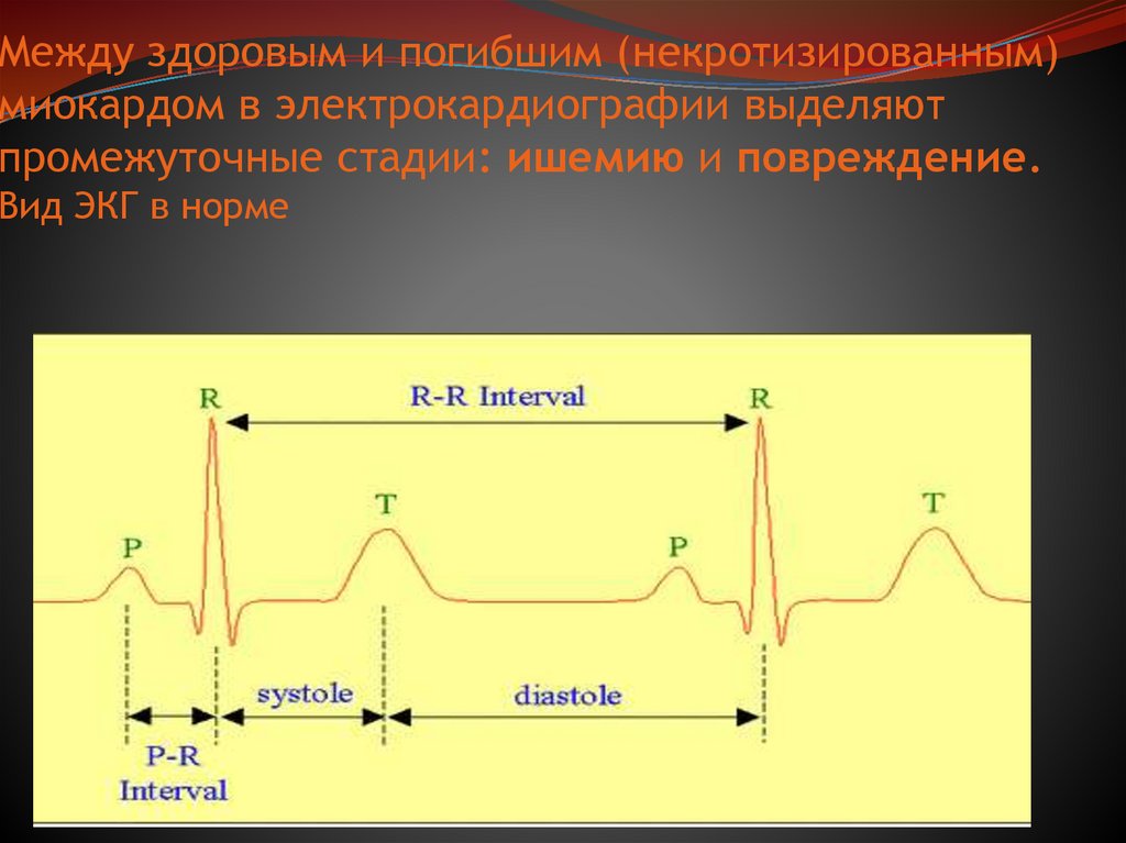 Между здоровым и погибшим (некротизированным) миокардом в электрокардиографии выделяют промежуточные