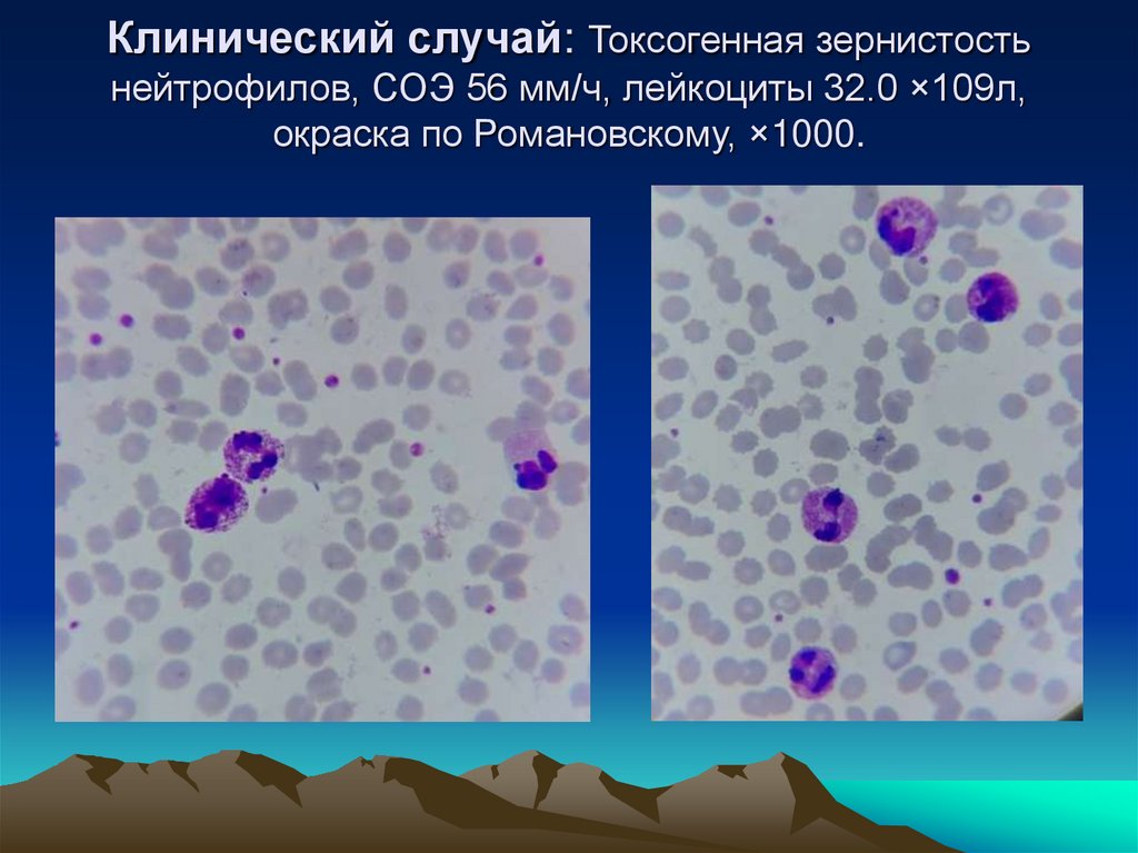 Клинический случай: Токсогенная зернистость нейтрофилов, СОЭ 56 мм/ч, лейкоциты 32.0 ×109л, окраска по Романовскому, ×1000.