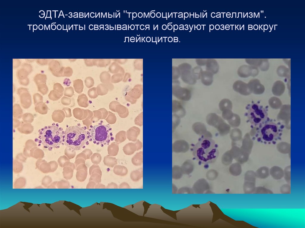 ЭДТА-зависимый "тромбоцитарный сателлизм". тромбоциты связываются и образуют розетки вокруг лейкоцитов.