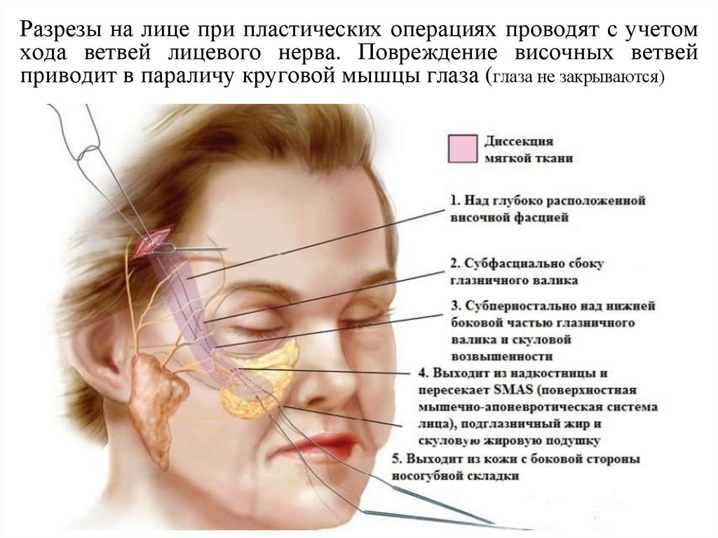 Разрезы на лице при пластических операциях проводят с учетом хода ветвей лицевого нерва. Повреждение височных ветвей приводит в