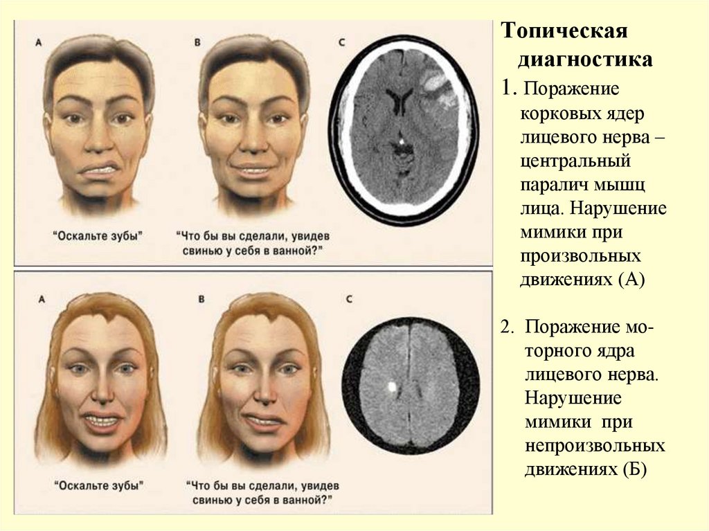 Топическая диагностика 1. Поражение корковых ядер лицевого нерва – центральный паралич мышц лица. Нарушение мимики при