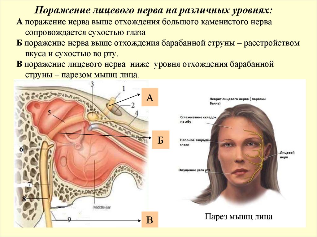 Поражение лицевого нерва на различных уровнях: А поражение нерва выше отхождения большого каменистого нерва сопровождается