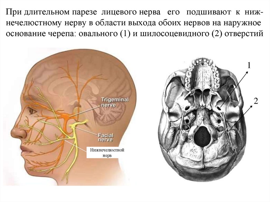 При длительном парезе лицевого нерва его подшивают к ниж- нечелюстному нерву в области выхода обоих нервов на наружное