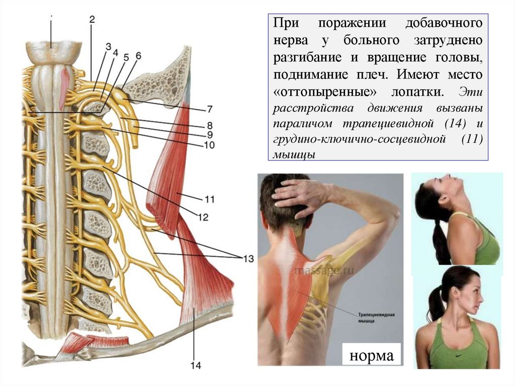 При поражении добавочного нерва у больного затруднено разгибание и вращение головы, поднимание плеч. Имеют место «оттопыренные»