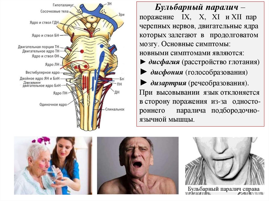 Бульбарный паралич – поражение IX, X, XI и XII пар черепных нервов, двигательные ядра которых залегают в продолговатом мозгу.
