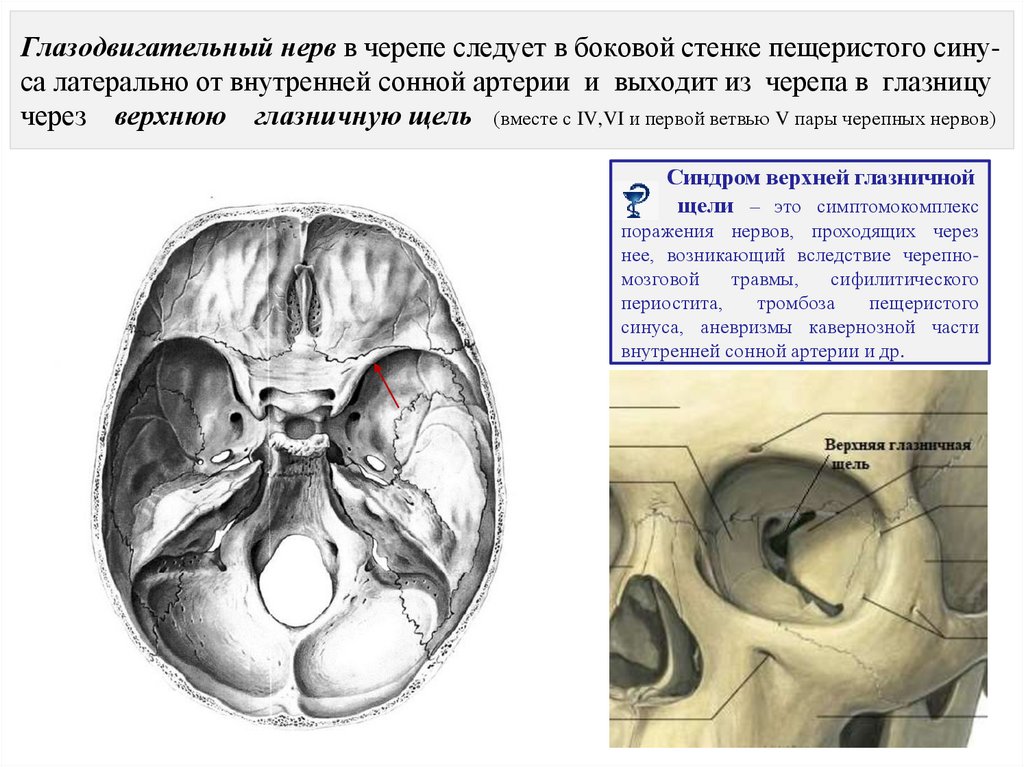 Глазодвигательный нерв в черепе следует в боковой стенке пещеристого сину- са латерально от внутренней сонной артерии и выходит