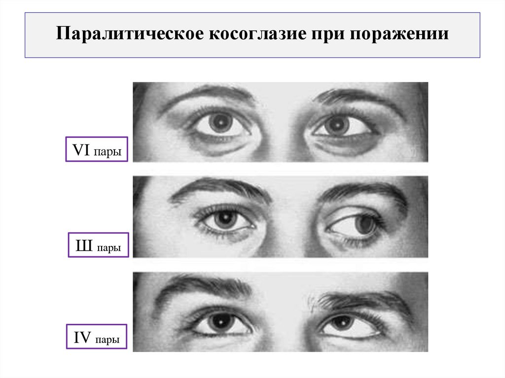 Паралитическое косоглазие при поражении
