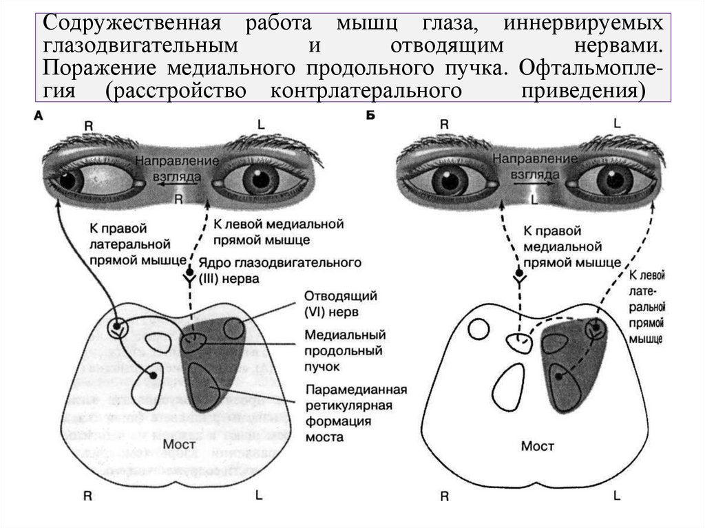 Содружественная работа мышц глаза, иннервируемых глазодвигательным и отводящим нервами. Поражение медиального продольного