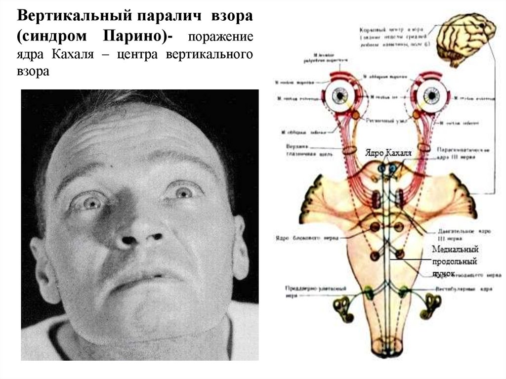 Вертикальный паралич взора (синдром Парино)- поражение ядра Кахаля – центра вертикального взора