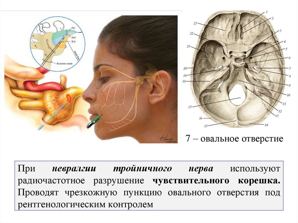 При невралгии тройничного нерва используют радиочастотное разрушение чувствительного корешка. Проводят чрезкожную пункцию