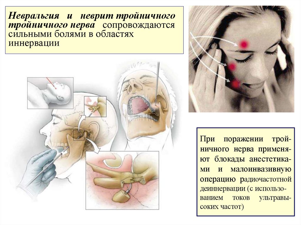 Невральгия и неврит тройничного тройничного нерва сопровождаются сильными болями в областях иннервации