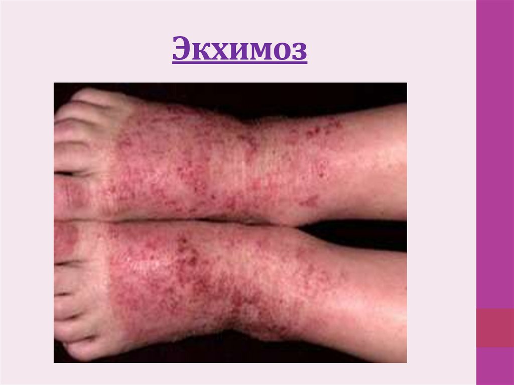 Экхимоз