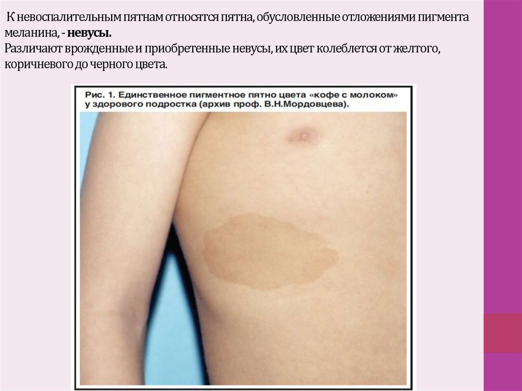 К невоспалительным пятнам относятся пятна, обусловленные отложениями пигмента меланина, - невусы. Различают врожденные и
