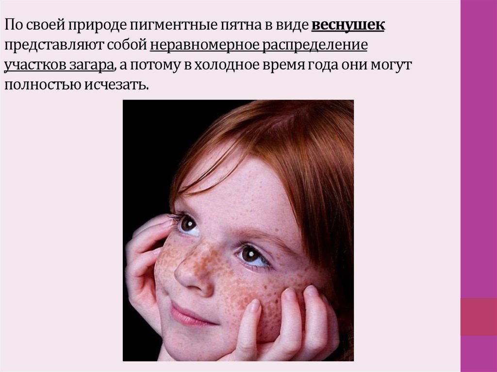 По своей природе пигментные пятна в виде веснушек представляют собой неравномерное распределение участков загара, а потому в