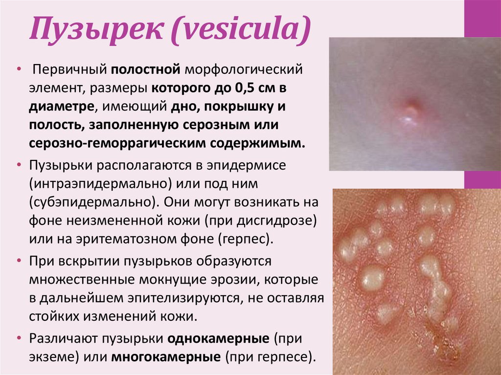 Пузырек (vesicula)