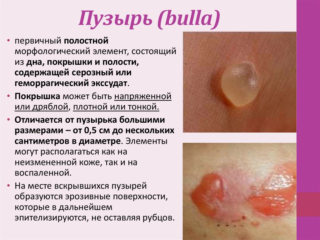 Пузырь (bulla)