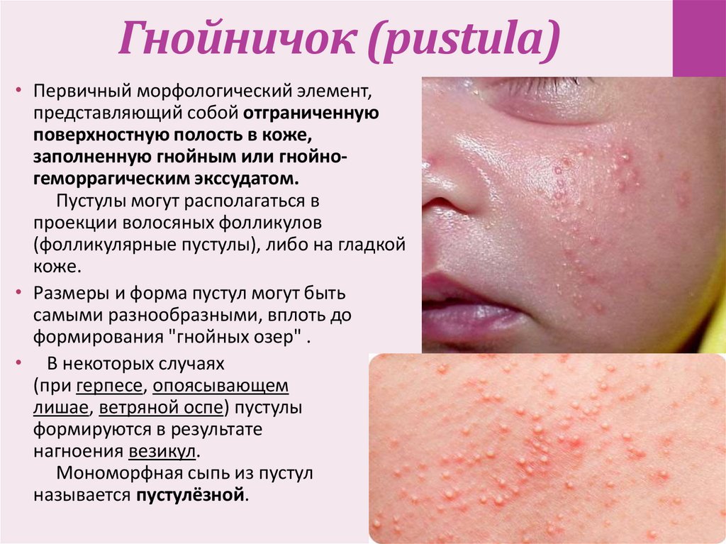 Гнойничок (pustula)
