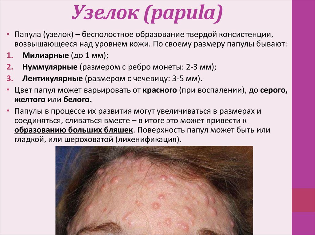 Узелок (papula)