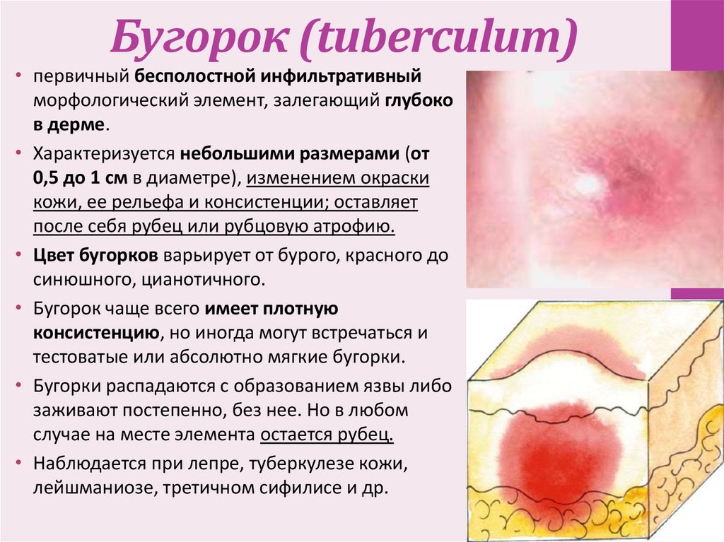 Бугорок (tuberculum)