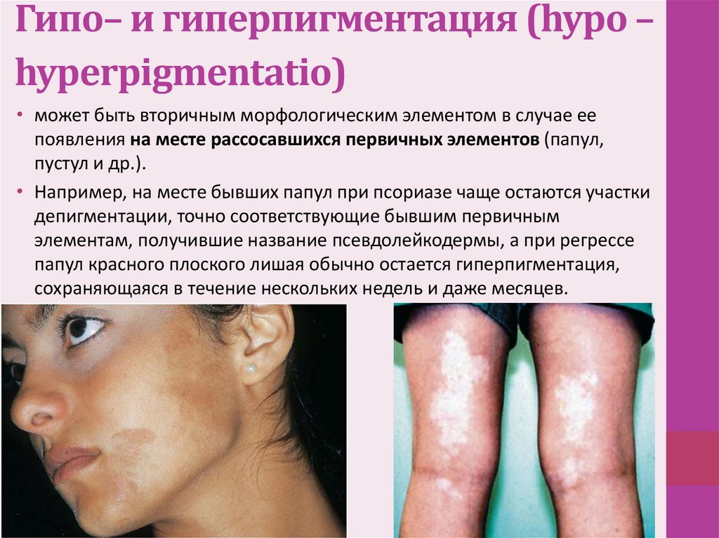 Гипо– и гиперпигментация (hypo – hyperpigmentatio) 