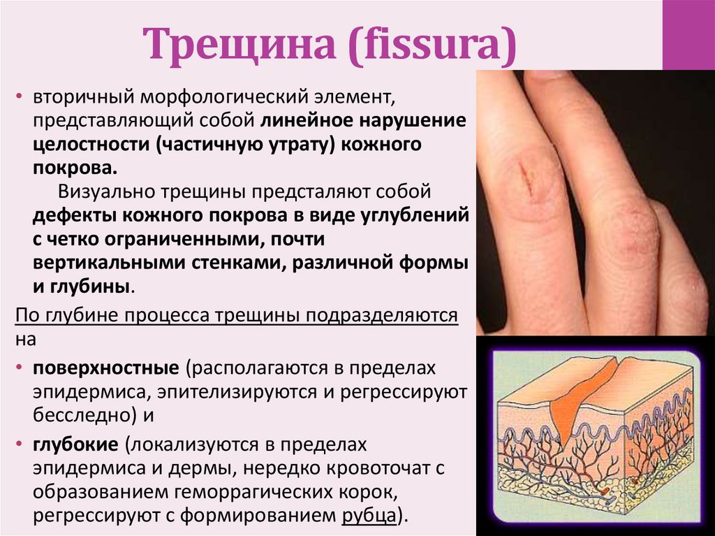 Трещина (fissura) 