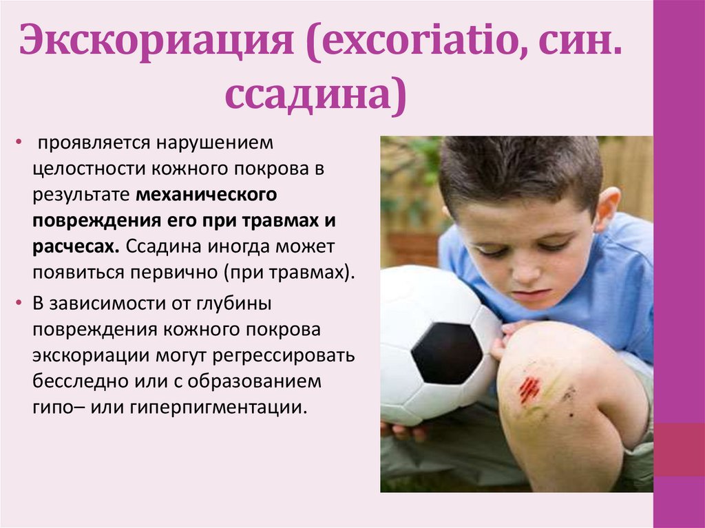 Экскориация (excoriatio, син. ссадина) 