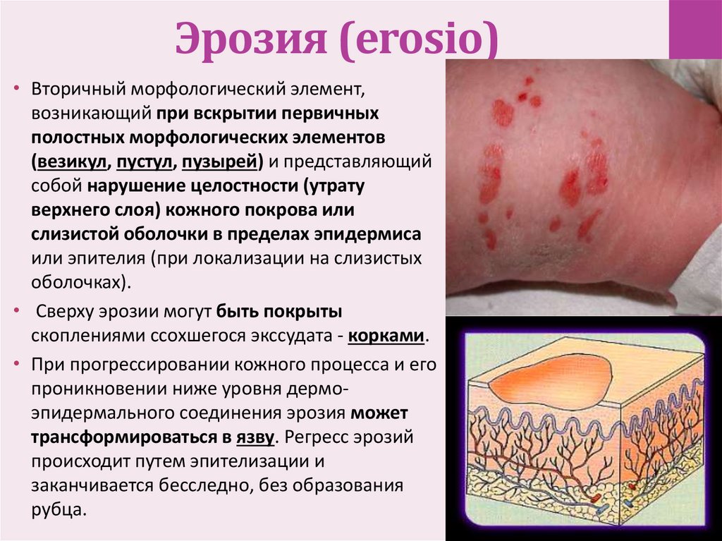 Эрозия (erosio)