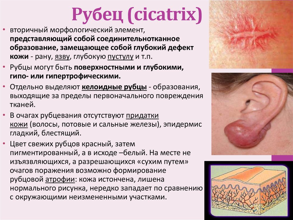 Рубец (cicatrix)
