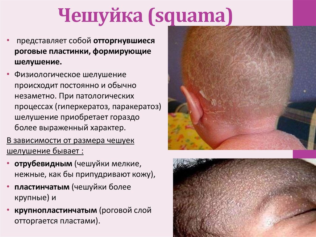 Чешуйка (squama)