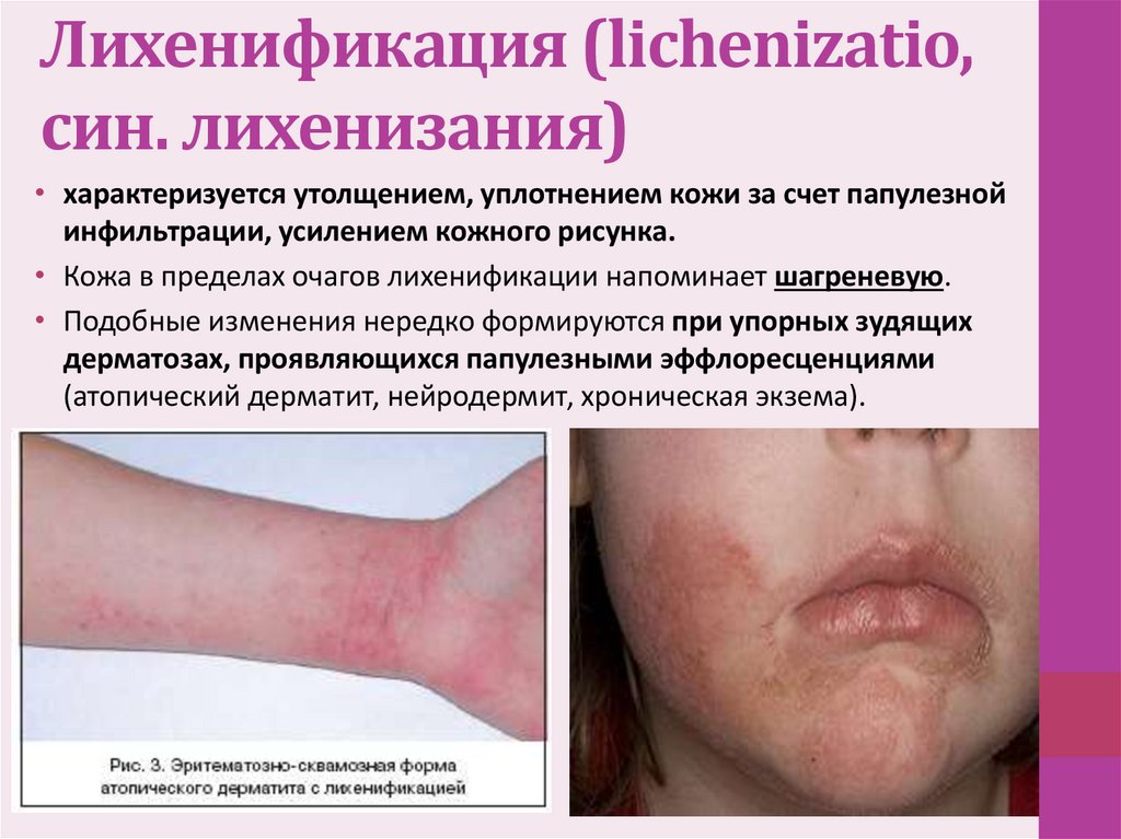 Лихенификация (lichenizatio, син. лихенизания) 