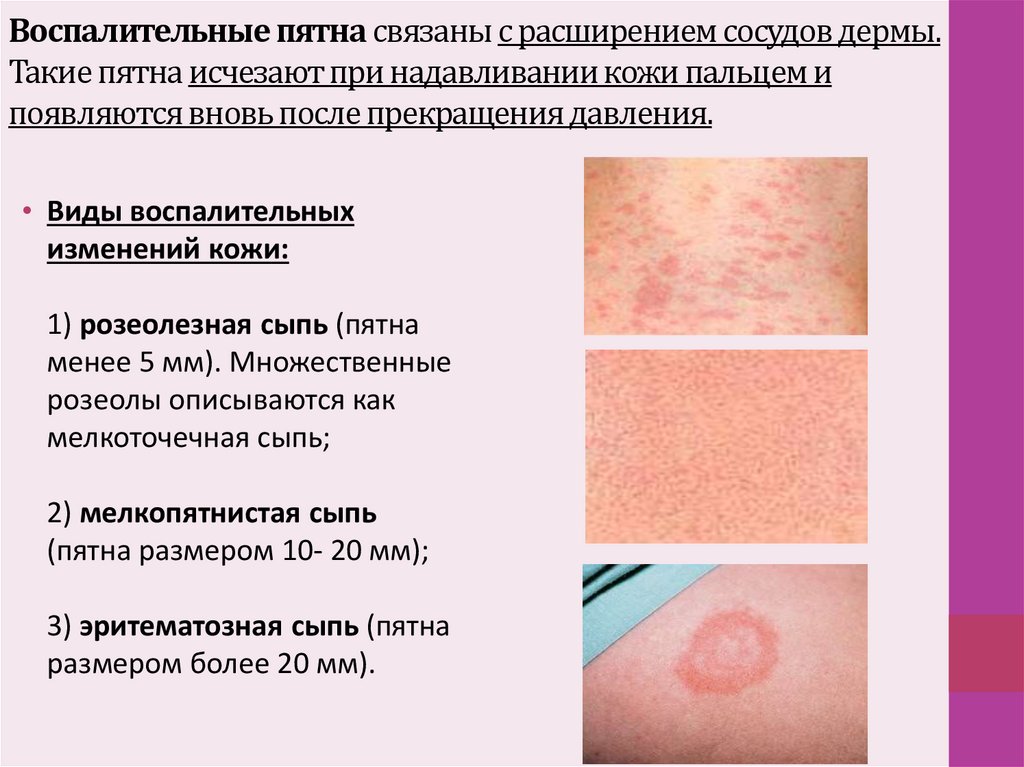 Воспалительные пятна связаны с расширением сосудов дермы. Такие пятна исчезают при надавливании кожи пальцем и появляются вновь