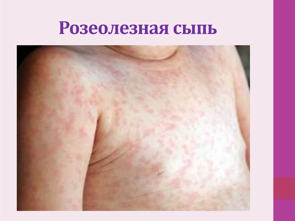 Розеолезная сыпь