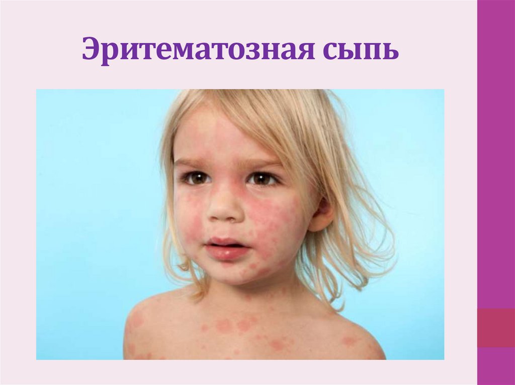 Эритематозная сыпь