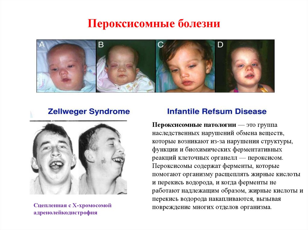 Пероксисомные болезни