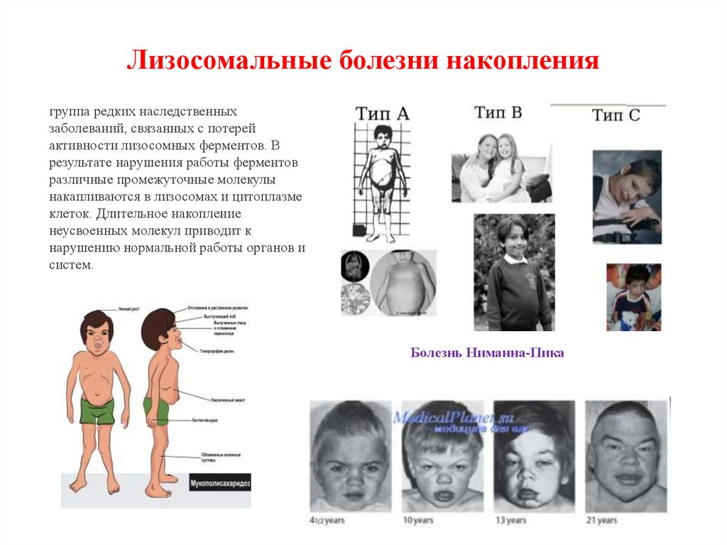 Лизосомальные болезни накопления